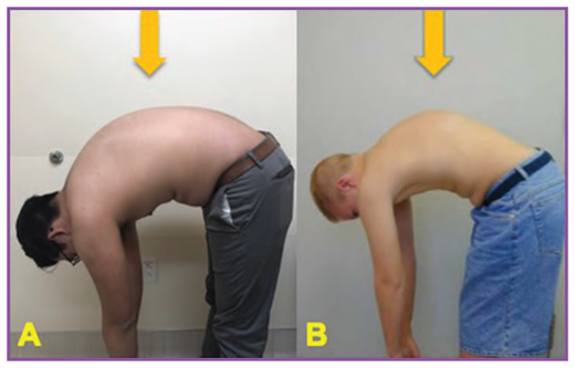 Adams forward bend test. Although when a patient is standing, postural kyphosis and Scheuermann kyphosis may appear similar, when asked to bend forward and viewed from the side a patient with postural kyphosis will have a normal smooth contour (arrow) (A) while a patient with Scheuermann kyphosis will have a sharp, angular appearance (arrow) (B).