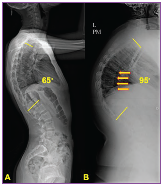 Lateral radiographs also illustrate the difference between postural kyphosis, in which the shape of the vertebral bodies is normal (A), and Scheuermann kyphosis, in which the vertebral bodies demonstrate wedging and end plate irregularities/Schmorl nodes (B). Straight lines indicate the kyphosis measured region; arrows in B indicate areas of vertebral wedging.