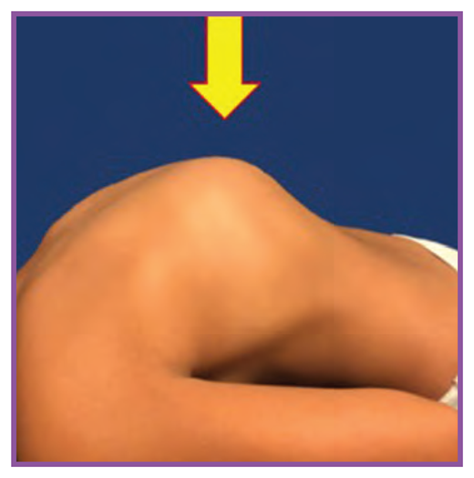 Adams forward bend test in a patient with congenital thoracolumbar kyphosis shows a rigid sharp, angular kyphosis.