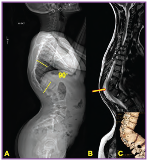 Lateral radiograph of the spine from a patient with severe thoracolumbar congenital kyphosis; straight lines indicate the kyphosis measured region (A). Sagittal T2-weighted magnetic resonance image demonstrates spinal cord compression over the apex of the deformity (arrow) (B). Three-dimensional computed tomography reconstruction shows congenital fusion at the thoracolumbar junction resulting in the severe congenital kyphosis (C).