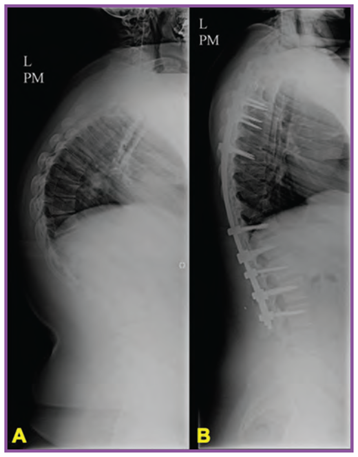 Radiographs from a 19-year-old with severe Scheuermann kyphosis of 95 degrees (A) who underwent posterior spinal fusion with instrumentation and experienced marked improvement in back pain (B).