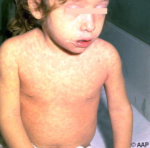 患有风疹的儿童表现出感觉痛苦的外观。