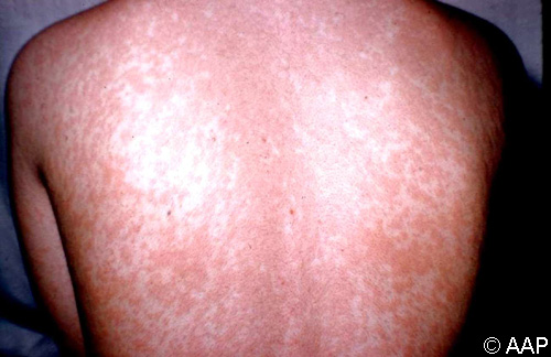 该儿童的背部出现特征性融合性麻疹(风疹)皮疹。