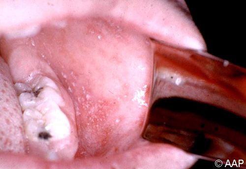 麻疹(风疹)。皮疹第二天的 Koplik 斑点。注意特征性白色皮损,边缘有红斑。