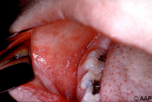 麻疹 (rubeola) 伴 Koplik 斑点。