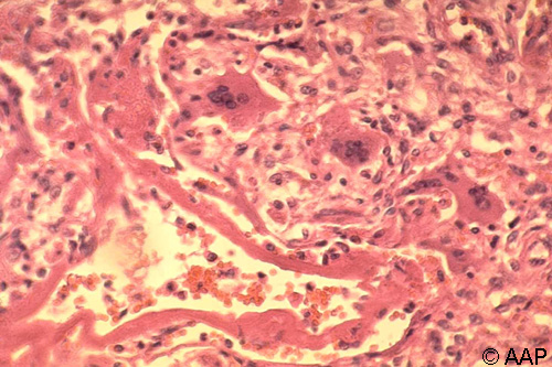 麻疹(风疹)肺炎伴间质性单核细胞浸润、多核巨细胞和透明膜(苏木精-伊红染色,原始放大倍数 ×250)。这与图 18 中的患者相同。