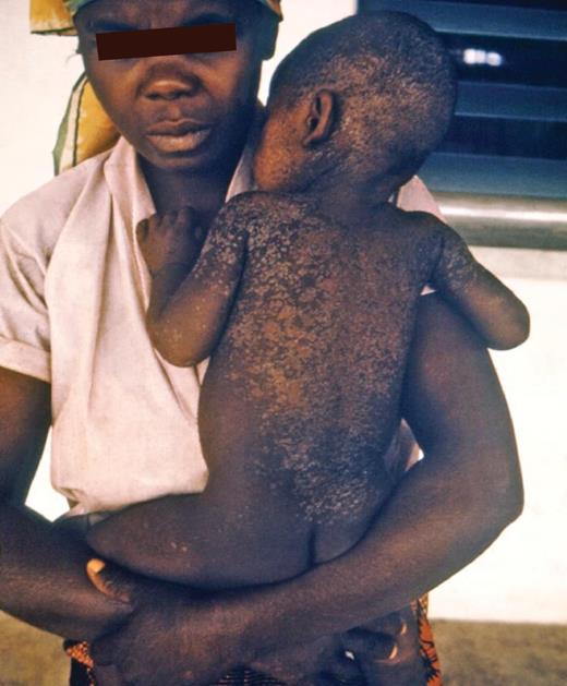 这张 1960 年代后期的照片展示了一位尼日利亚母亲和她的孩子,他们正在从麻疹中康复。请注意,当孩子从麻疹感染中痊愈时,孩子身上的皮肤会脱落。这个孩子是在尼日利亚-比夫拉战争期间疾病控制和预防中心领导的难民救济工作期间建立的营地中得到照顾的许多人之一。麻疹在这些营地中是一个持续的威胁。恢复中的麻疹患者的皮肤脱落通常是广泛的,类似于烧伤患者的皮肤脱落。由于身体虚弱,像这里显示的儿童需要护理以避免后续感染。由美国疾病控制与预防中心提供