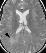 该轴向 T2 加权磁共振图像显示白质高信号的不对称右三角周病灶,与麻疹脑炎患者的早期脱髓鞘一致。