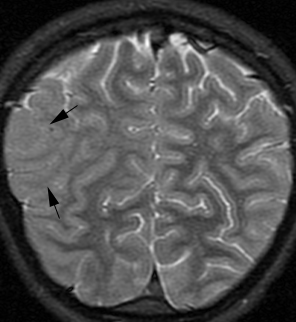 这张冠状位 T2 加权磁共振图像显示了麻疹脑炎患者右侧顶枕叶皮层(箭头)的肿胀和高信号。