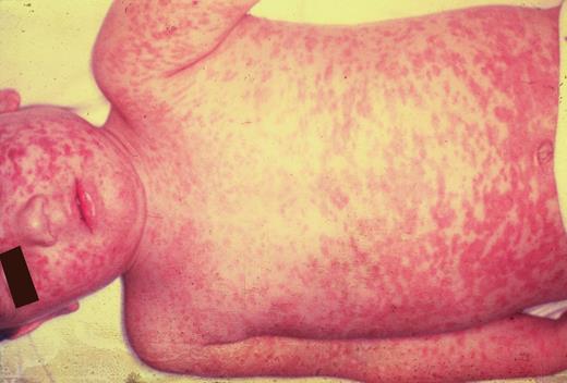 一名 2 岁儿童的麻疹 (rubeola) 近乎融合的皮疹。由医学博士 Paul Wehrle 提供