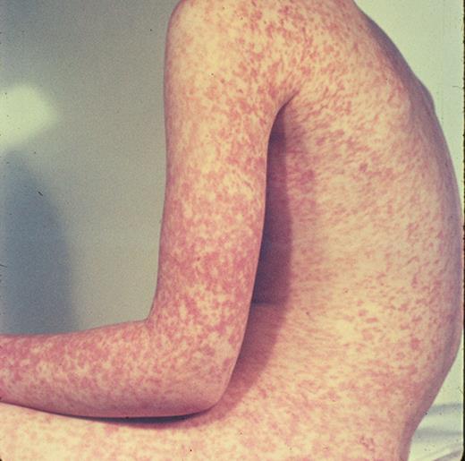 一名 7 岁儿童患麻疹。由医学博士 Paul Wehrle 提供