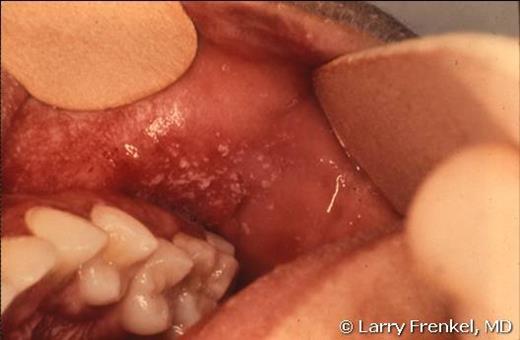 一名 7 岁儿童的 Koplik 麻疹斑点。由医学博士 Larry Frenkel 提供