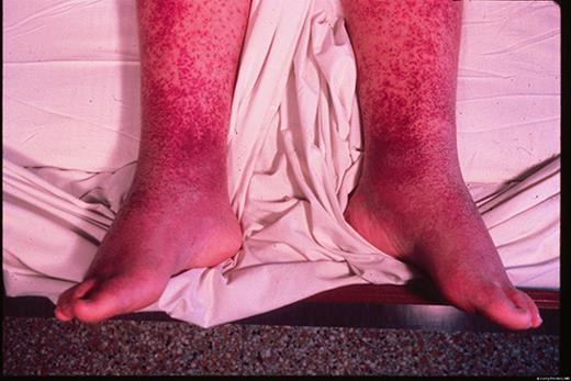 一名患有非典型麻疹的 15 岁儿童。由医学博士 Larry Frenkel 提供