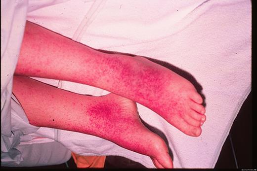 一名患有非典型麻疹的 15 岁儿童。由医学博士 Larry Frenkel 提供