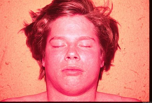 一名患有非典型麻疹的 15 岁儿童。由医学博士 Larry Frenkel 提供