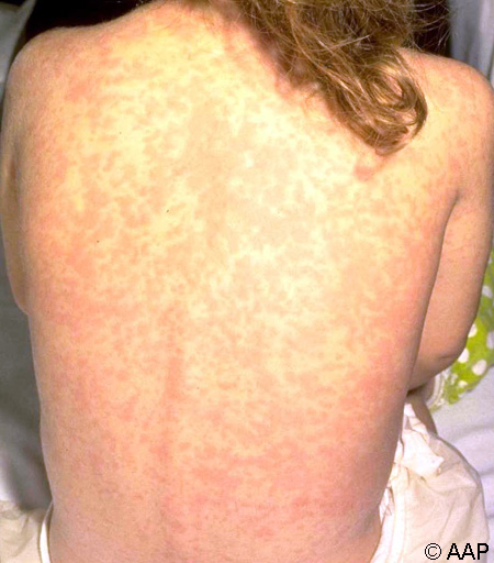 Measles (rubeola). This is the same patient in Figure 1.