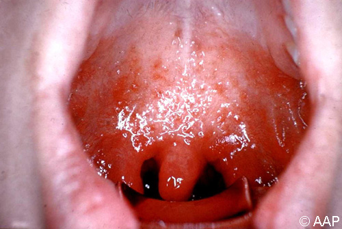 Measles (rubeola) pharyngitis in an adult showing striking inflammation.