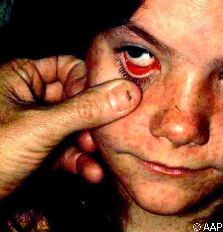 Measles (rubeola) rash and conjunctivitis. Conjunctivitis results in clear tearing. Photophobia is common.