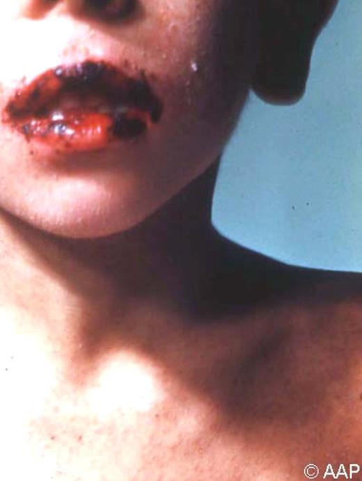 Hemorrhagic measles (black measles). Although uncommon, hemorrhagic measles may result in bleeding from the mouth, nose, and gastrointestinal tract. Courtesy of Edgar O. Ledbetter, MD, FAAP