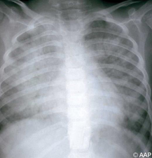 Measles (rubeola) pneumonia in a 6-year-old with acute lymphoblastic leukemia. The child died of respiratory failure.