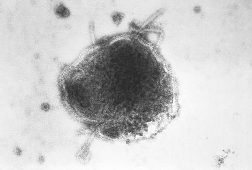 This electron micrograph reveals a paramyxovirus measles virus and virions of the polyomavirus, simian virus SV40. Courtesy of Centers for Disease Control and Prevention