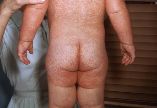 This child with measles is showing the characteristic red blotchy rash on the buttocks and back during the third day of the rash. Measles is an acute, highly communicable viral disease with prodromal fever, conjunctivitis, coryza, cough, and Koplik spots on the buccal mucosa. A red, blotchy rash appears around day 3 of the illness, first on the face and then becoming generalized. Courtesy of Centers for Disease Control and Prevention