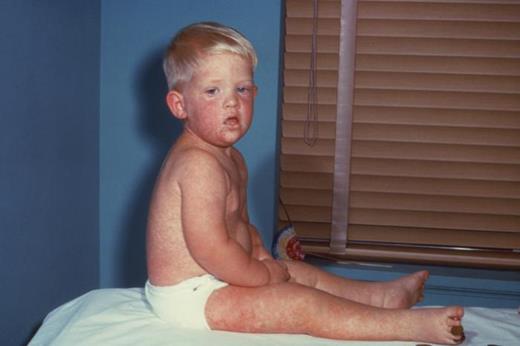 This child with measles is displaying the characteristic red blotchy pattern on the face and body during the third day of the rash. Courtesy of Centers for Disease Control and Prevention