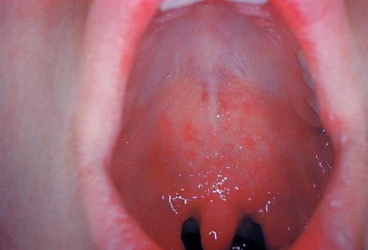 This was a patient who presented with Koplik spots on the palate due to preeruptive measles on day 3 of the illness. Measles is an acute, highly communicable viral disease with fever, conjunctivitis, coryza, cough, and Koplik spots. Koplik spots are small, red, irregularly shaped spots with blue-white centers found on the mucosal surface of the oral cavity. Courtesy of Centers for Disease Control and Prevention