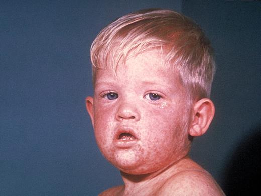 The face of a child with measles on the third day of the rash. Courtesy of Centers for Disease Control and Prevention