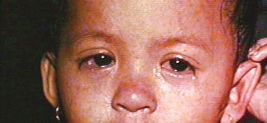 A child with measles rash and conjunctivitis. Courtesy of Centers for Disease Control and Prevention