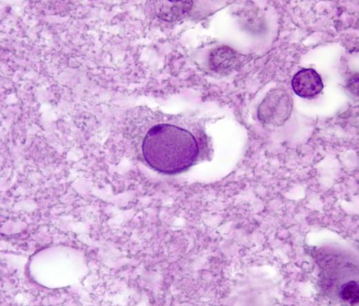 Measles encephalitis in a patient who was immunosuppressed who underwent renal transplantation with viral intranuclear inclusion. Courtesy of Dimitris P. Agamanolis, MD