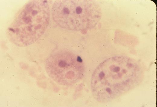 A pharyngeal smear from the child in Figure 11 demonstrating epithelial giant cells found in the prodromal stage of measles (hematoxylin-eosin stain). Courtesy of Paul Wehrle, MD