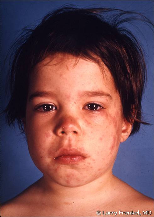 A 6-year-old with the early facial rash and conjunctivitis of measles. Courtesy of Larry Frenkel, MD