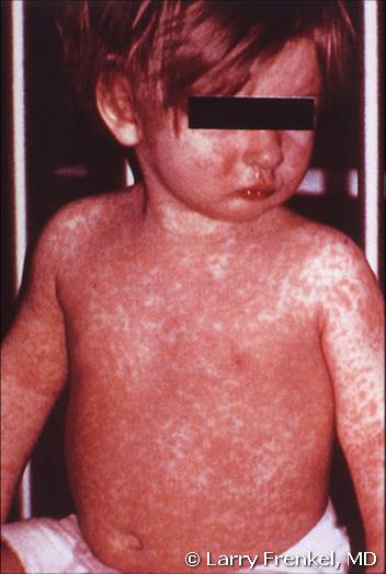 A 2-year-old with the confluent rash of measles. Courtesy of Larry Frenkel, MD