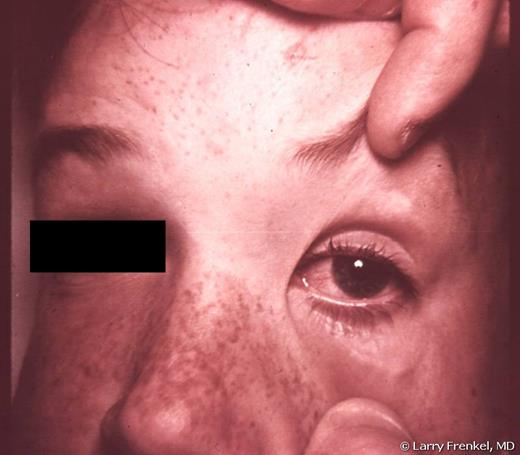 Measles conjunctivitis in a 7-year-old. Courtesy of Larry Frenkel, MD