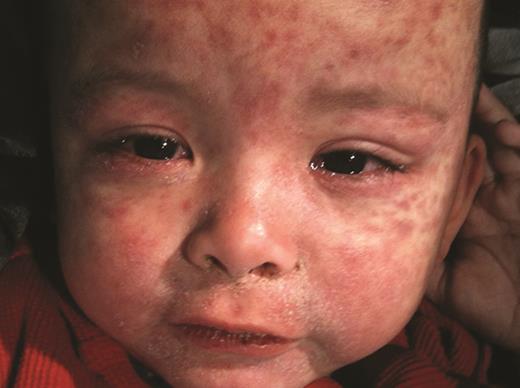 This unvaccinated 11-month-old acquired measles while traveling to the Philippines to visit relatives. Note the bilateral conjunctivitis, crusting rhinorrhea, and morbilliform rash; he also had a prominent staccato cough. Courtesy of Carol J. Baker, MD