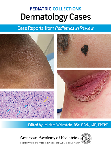 Infant Rash Directory Rash in a 2-month-old Premature Infant | Pediatric Collections ...