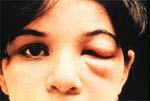 Romaña's sign, the swelling of the child's eyelid, is a marker of acute Chagas disease. The swelling is due to bug feces being accidentally rubbed into the eye, or because the bite wound was on the same side of the child's face as the swelling. Photo courtesy of WHO/TDR.