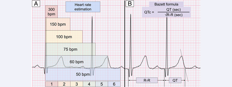 The Pediatric Electrocardiogram | AAP Journal Blogs | American Academy ...