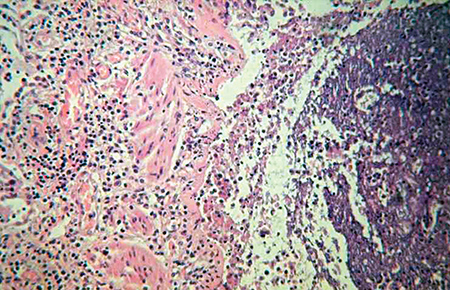 FYI: New bronchiolitis algorithm released | AAP News | American Academy ...