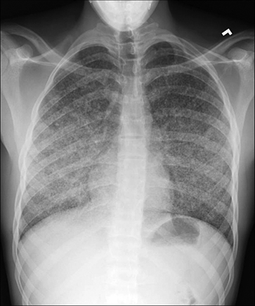 Differential diagnosis for this radiograph includes tuberculosis, metastatic thyroid carcinoma, vasculitis, sarcoid and histiocytosis. Courtesy of H. Cody Meissner, M.D., FAAP