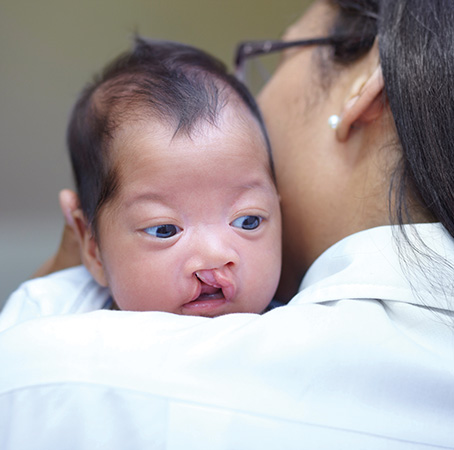 Cleft lip and/or cleft palate (CL/P) are among the most common birth defects.