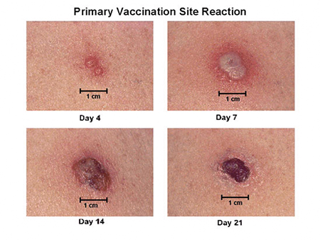 Photos courtesy of the Centers for Disease Control and Prevention
