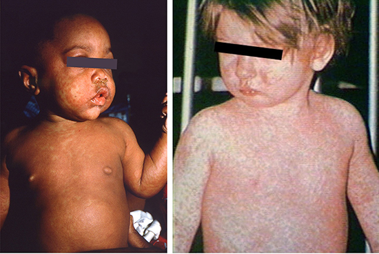 New resources available as measles cases continue to rise | AAP News ...