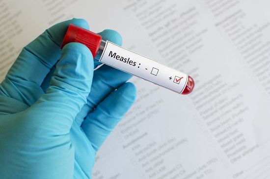 Measles blood test in a vial.