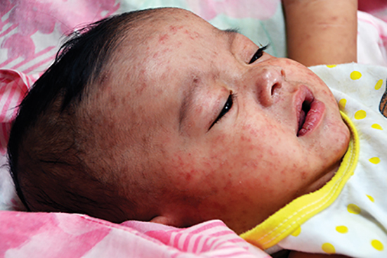Baby with measles.