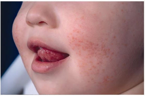 Hepatitis B Rashes Why we give the hepatitis B vaccine at birth | AAP News | American ...