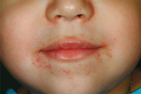 Perioral Rash In Children Perioral dermatitis in children: A childhood form of rosacea | AAP News ...