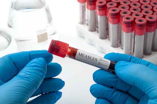 South Carolina’s measles outbreak ends after nearly 1,000 cases, 21 ...