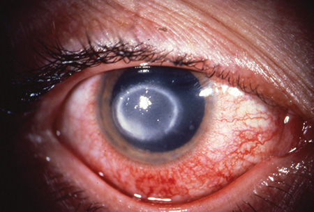 Inflammation of the cornea (keratitis) manifests as pain, tearing, redness and blurring of vision. Photo courtesy of the 2015 AAP Red Book.
